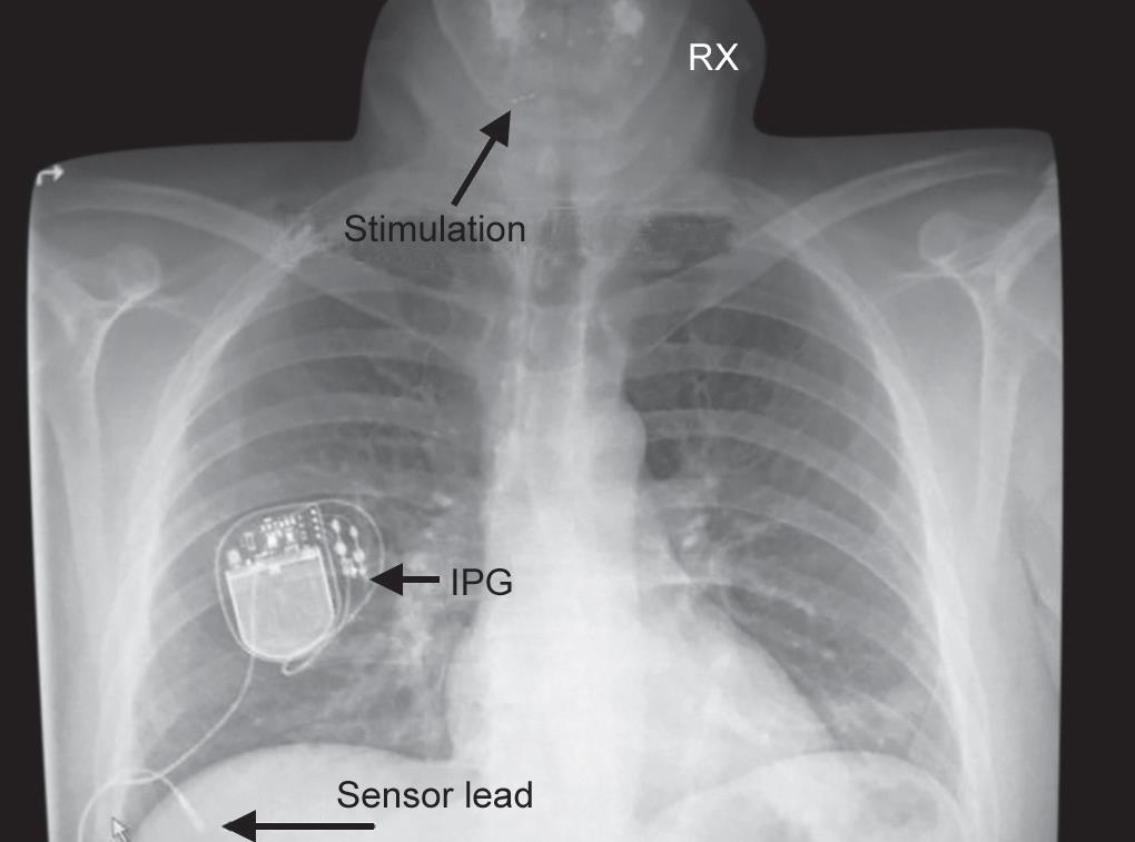 Hypoglossal Nerve Stimulator Surgery: Postoperative Care, Device Settings &  Side Effects