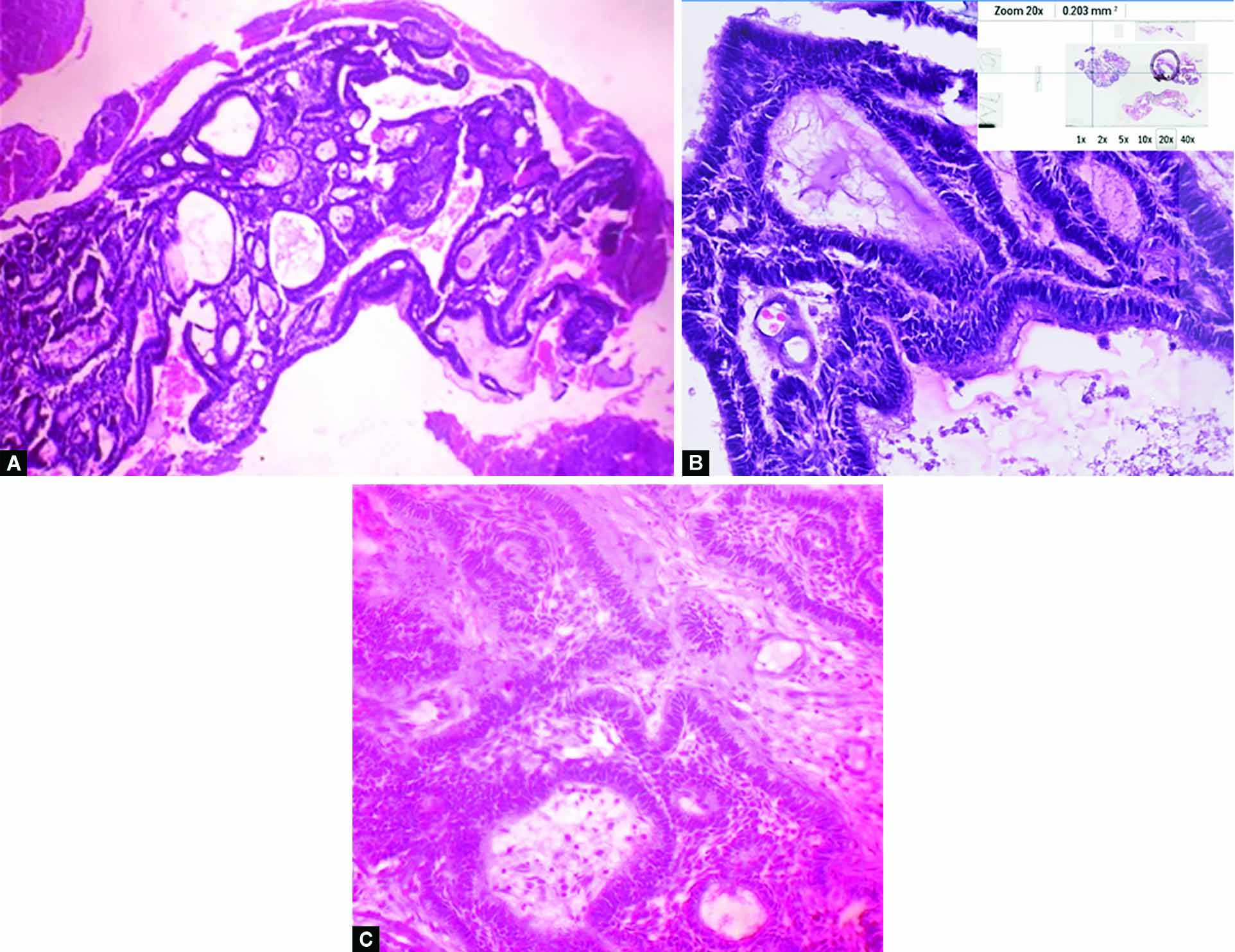 Antrochoanal Polyp Histology