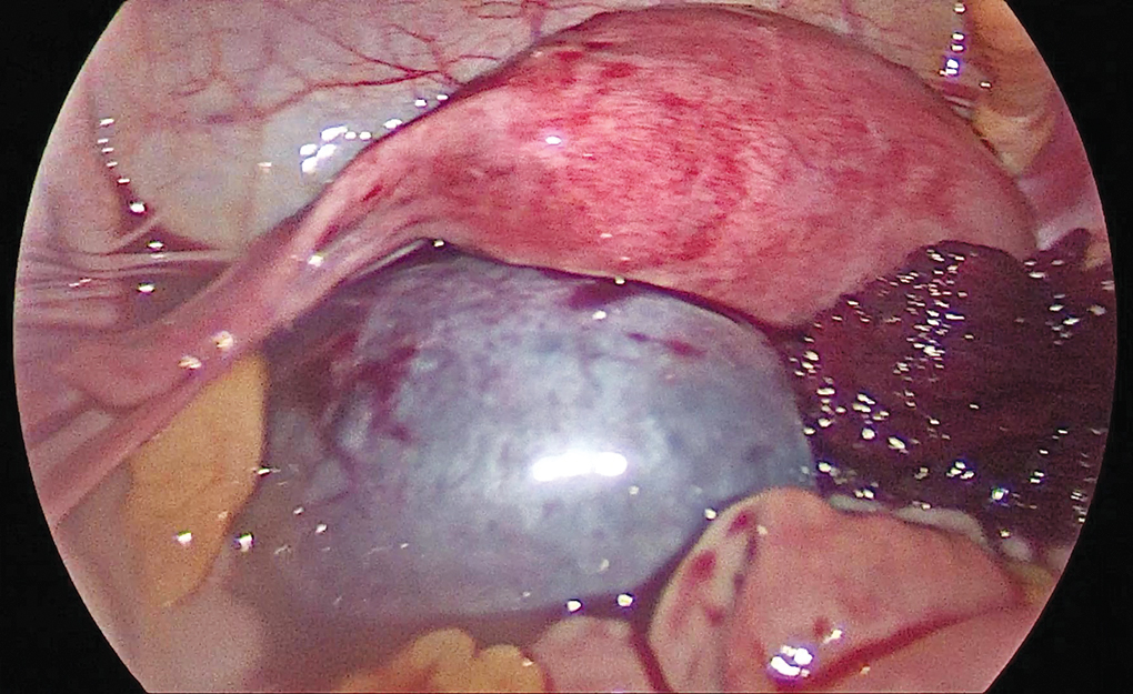 Laparoscopic Ovarian Detorsion in Stimulation Cycle of IVF Prior Oocyte  Retrieval and a Successful Outcome: A Rare Case Report, image size:1020x625