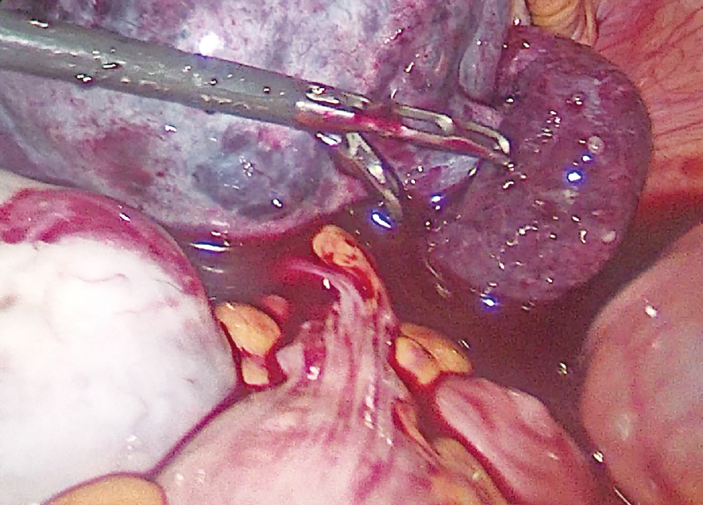 Ovarian torsion and infarction | Radiology Case | Radiopaedia.org, image size:1020x733