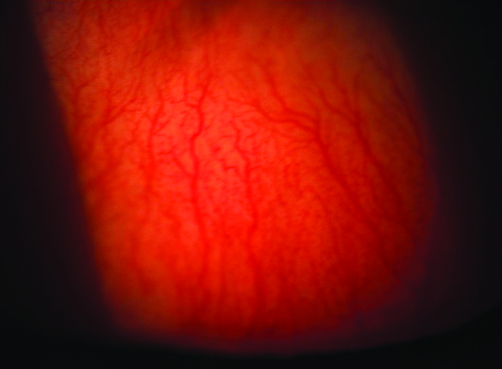 Very Asymmetric Keratoconus A Case Report of Longterm Followup