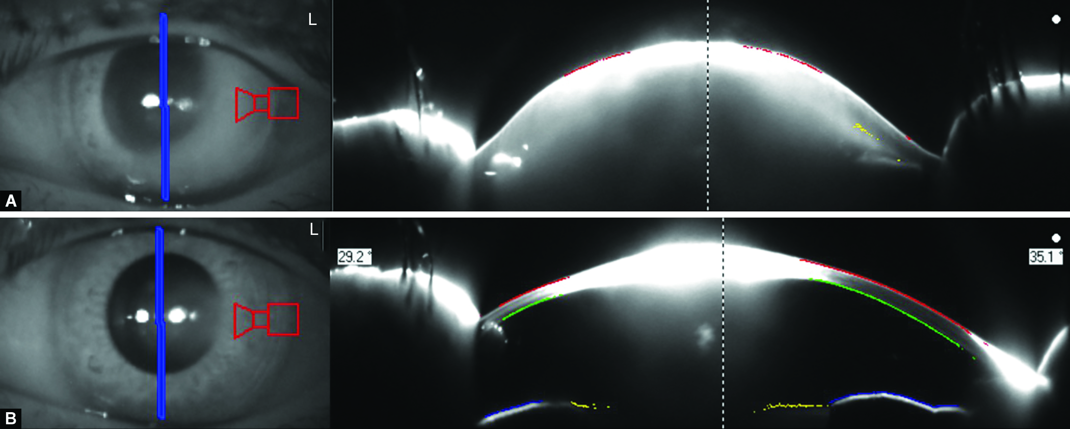 Very Asymmetric Keratoconus A Case Report of Longterm Followup