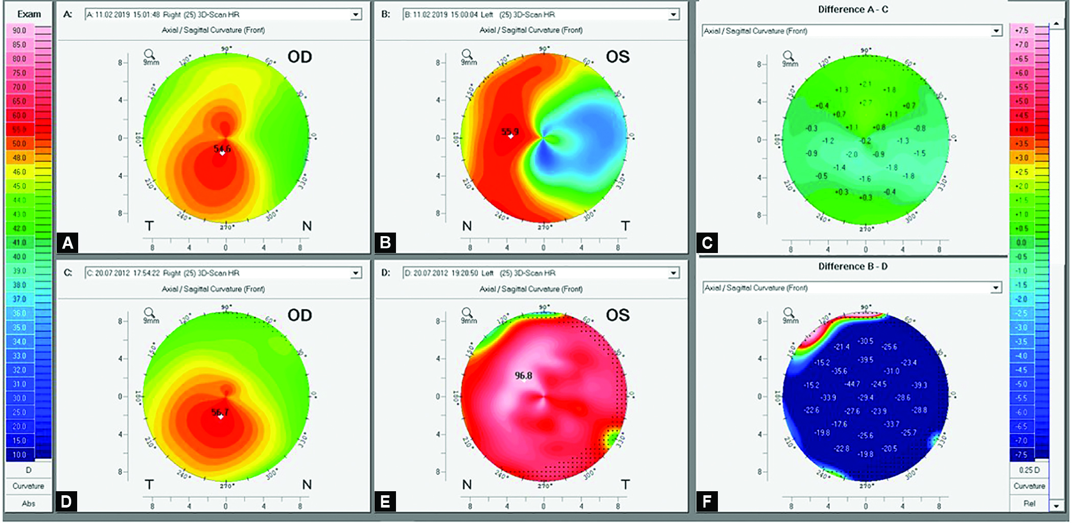 Very Asymmetric Keratoconus A Case Report of Longterm Followup