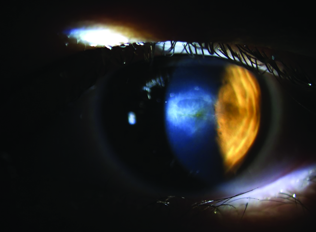 Very Asymmetric Keratoconus A Case Report of Longterm Followup