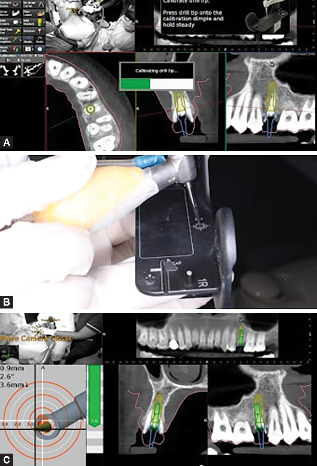 Comparative Evaluation of the Accuracy and Occlusal Equilibrium of ...