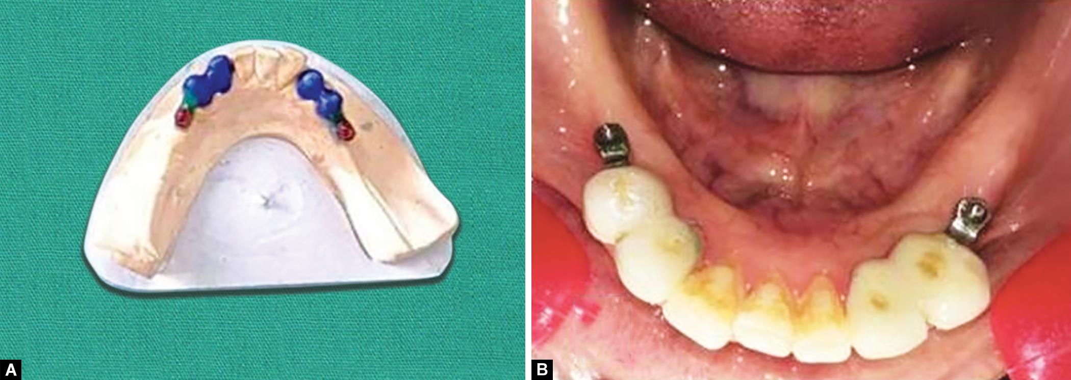 Contemporary Approach of Distal Extension Rehabilitation with Precision