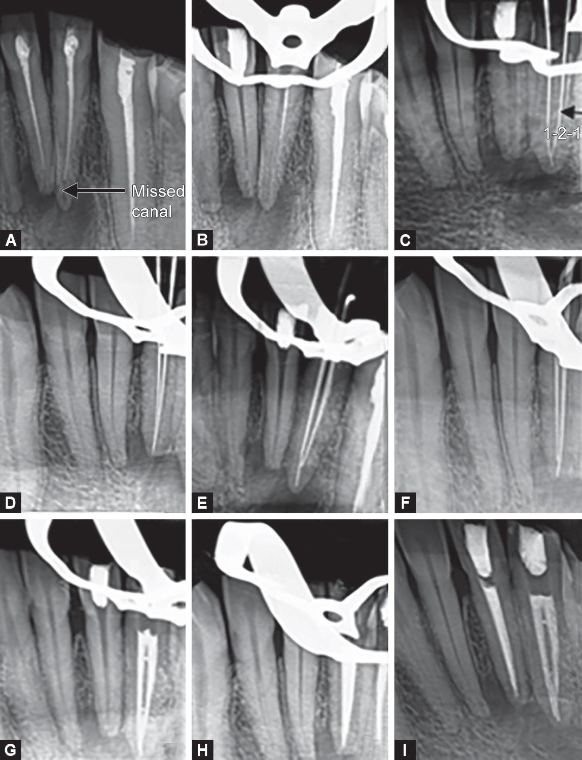 Endodontic Failure due to Variations in Root Canal Anatomy in Permanent