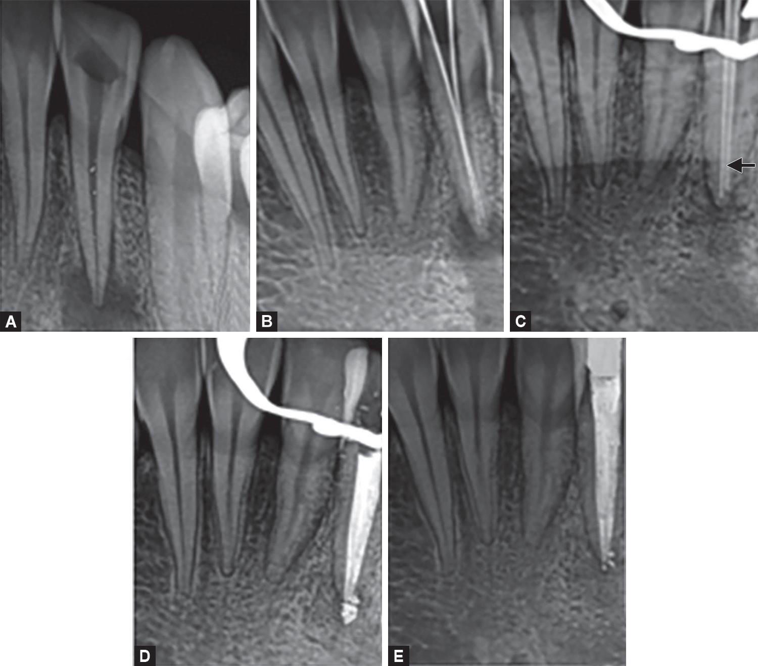 Endodontic Failure due to Variations in Root Canal Anatomy in Permanent