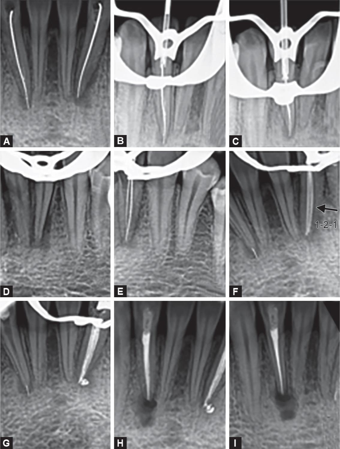 Endodontic Failure due to Variations in Root Canal Anatomy in Permanent