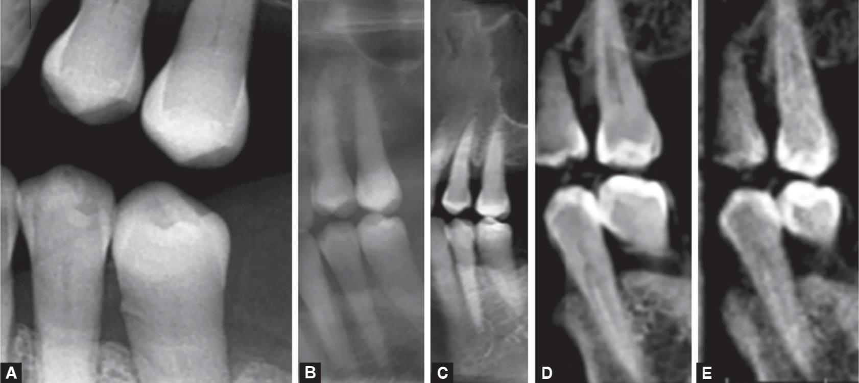Accuracy of Conebeam Computed Tomography and Extraoral Bitewings