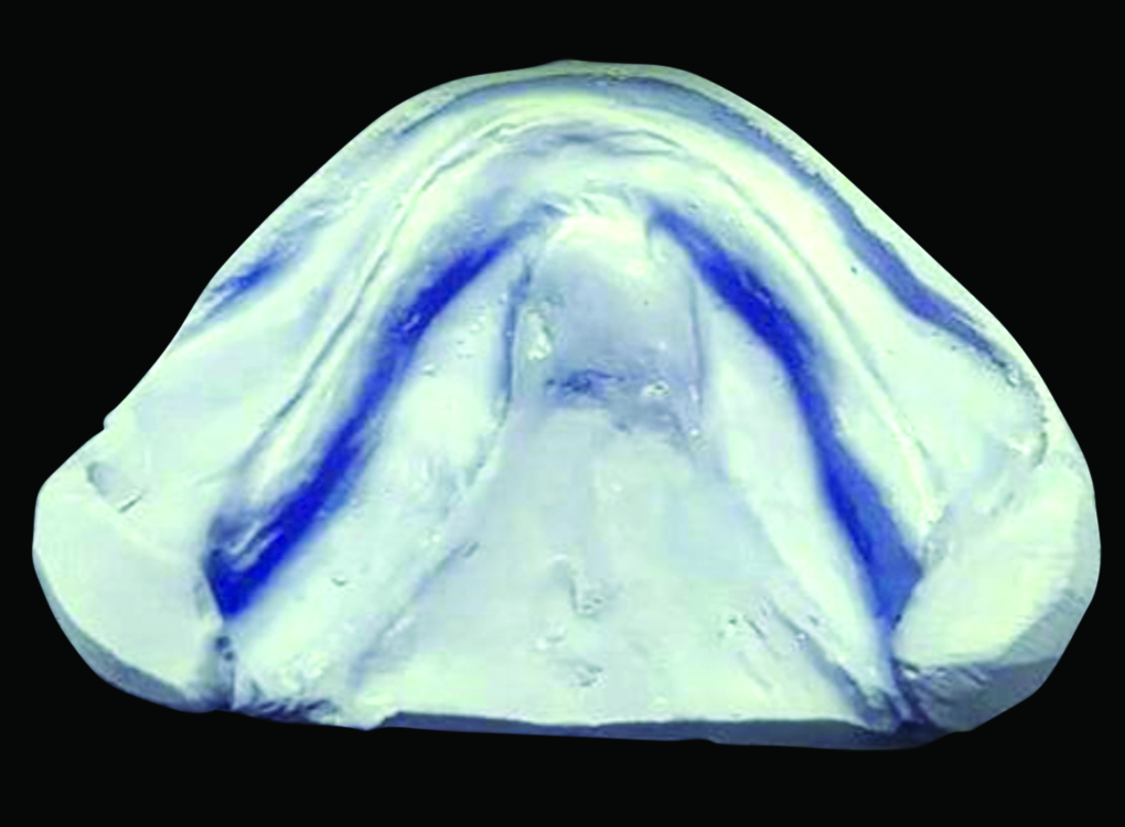 Effect of Different Definitive Impression Techniques for Resorbed