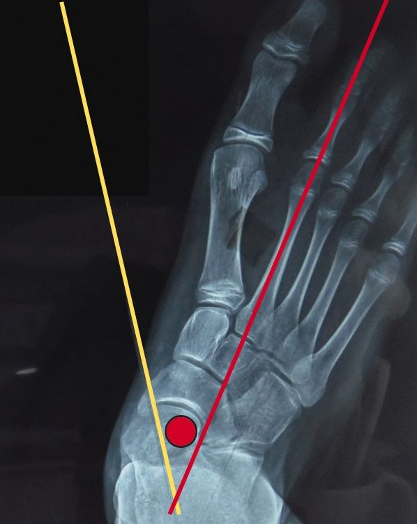 File:X-ray of a normal foot of a 12 year old male - dorsoplantar