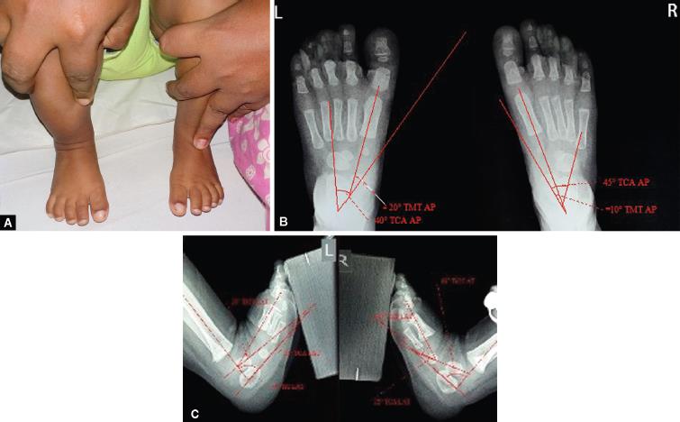 Radiographic Measurements For Clubfoot
