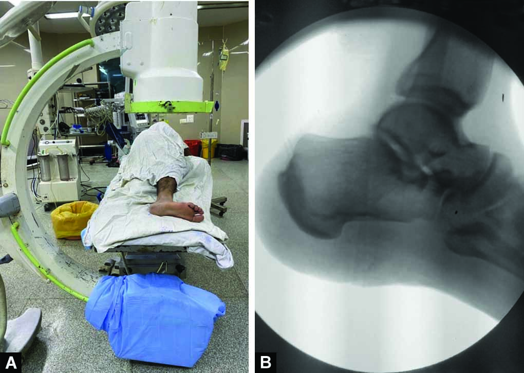 Update more than 128 x ray heel lateral view esthdonghoadian