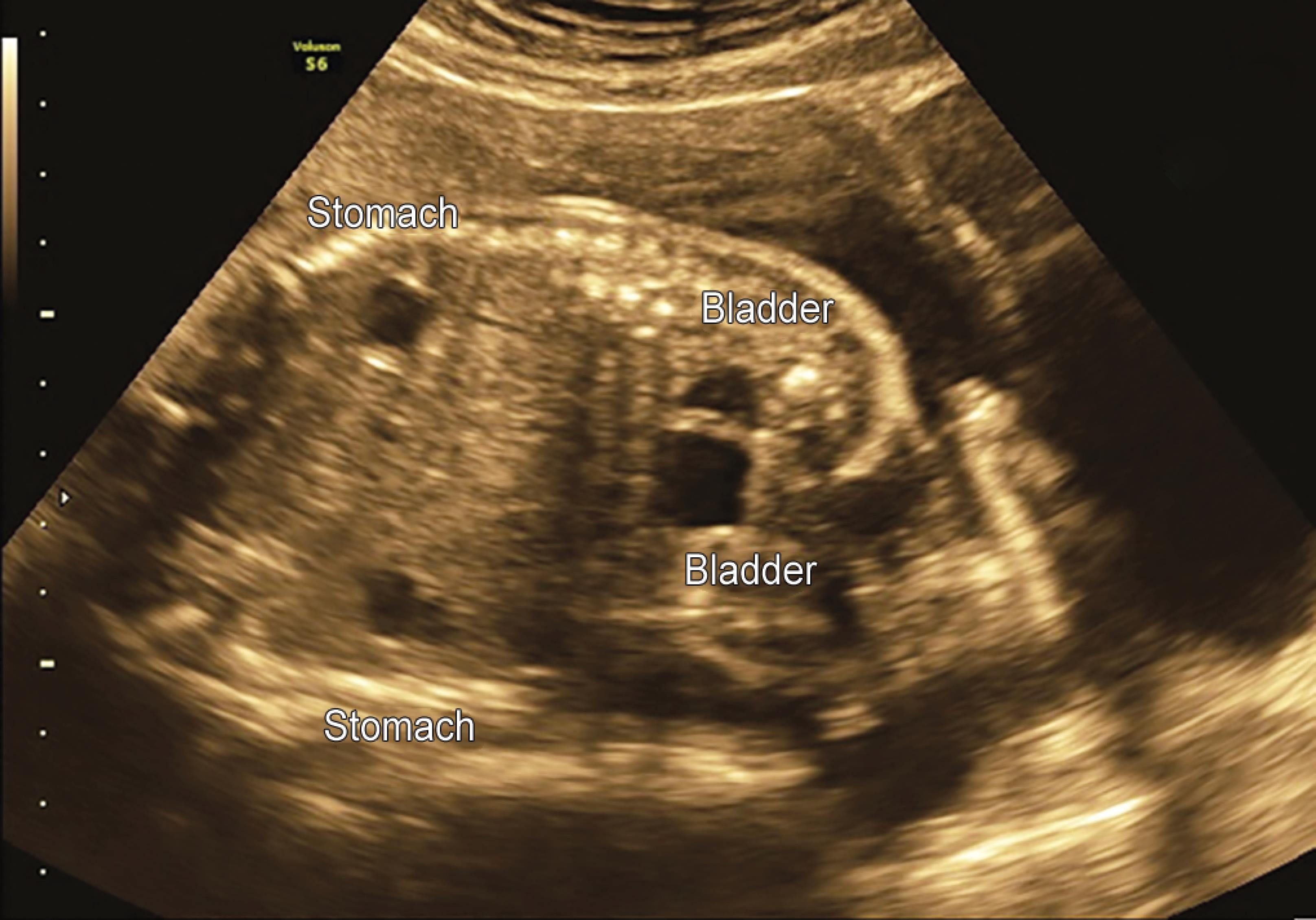 Thoraco Omphalopagus Conjoined Twins A Rare Case Report