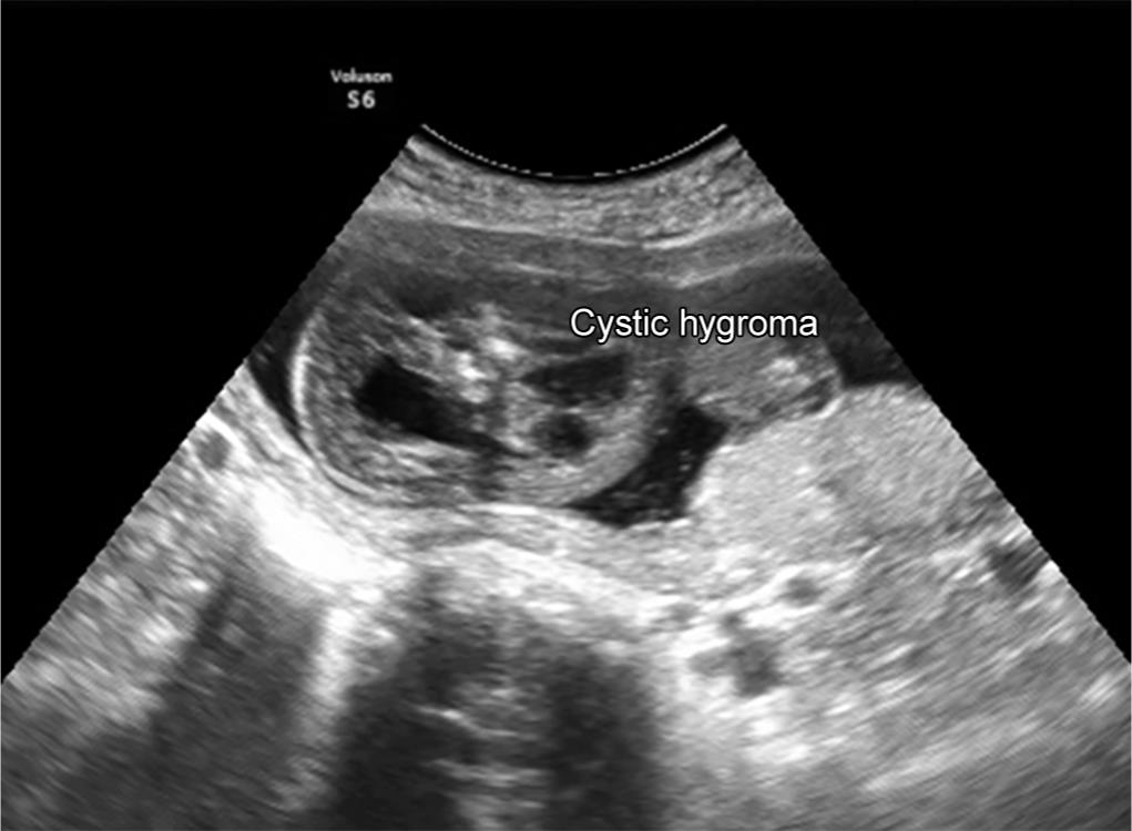 cystic hygroma ultrasound