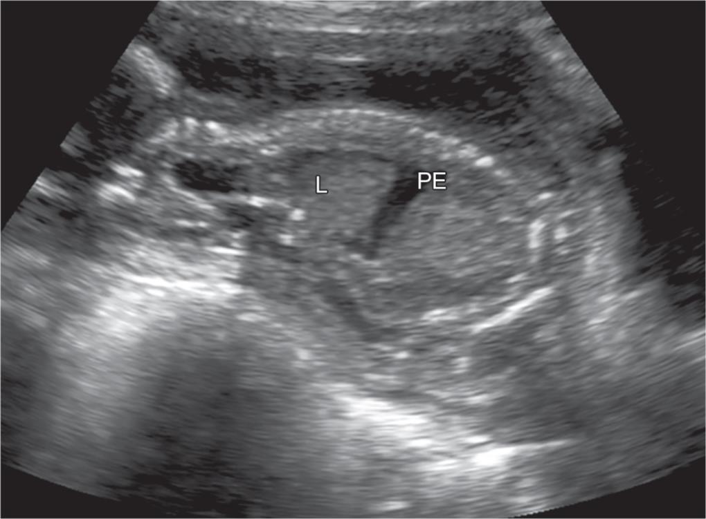 fetal pleural effusion ultrasound