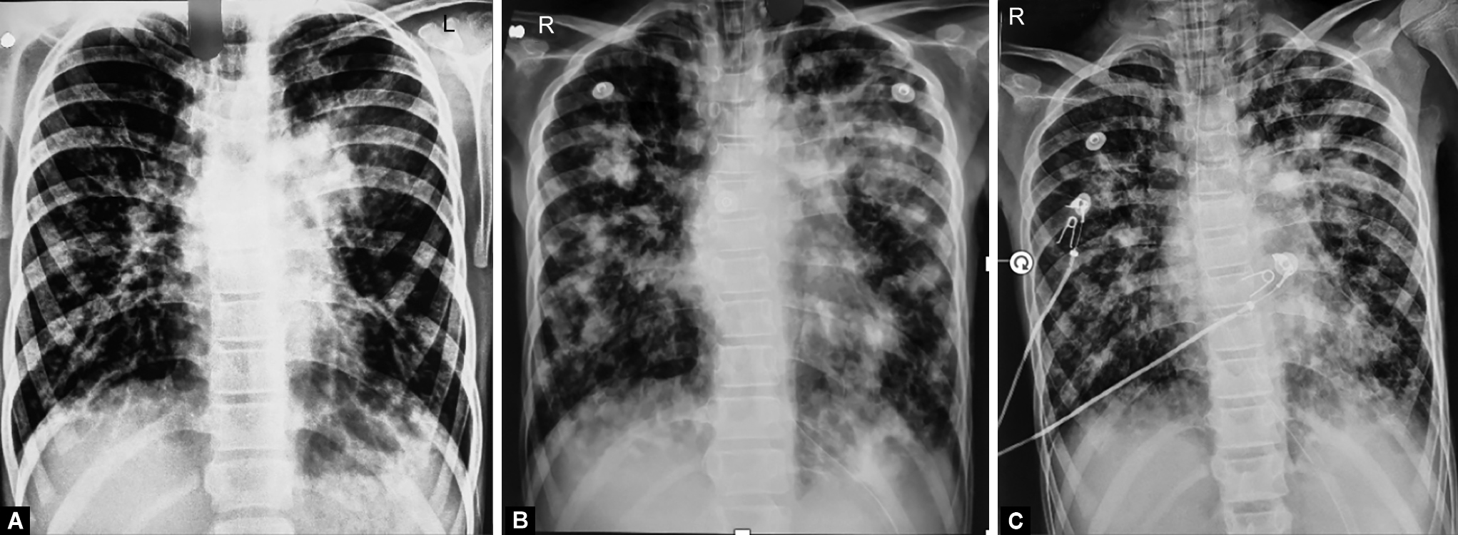 case study of pneumonia in child