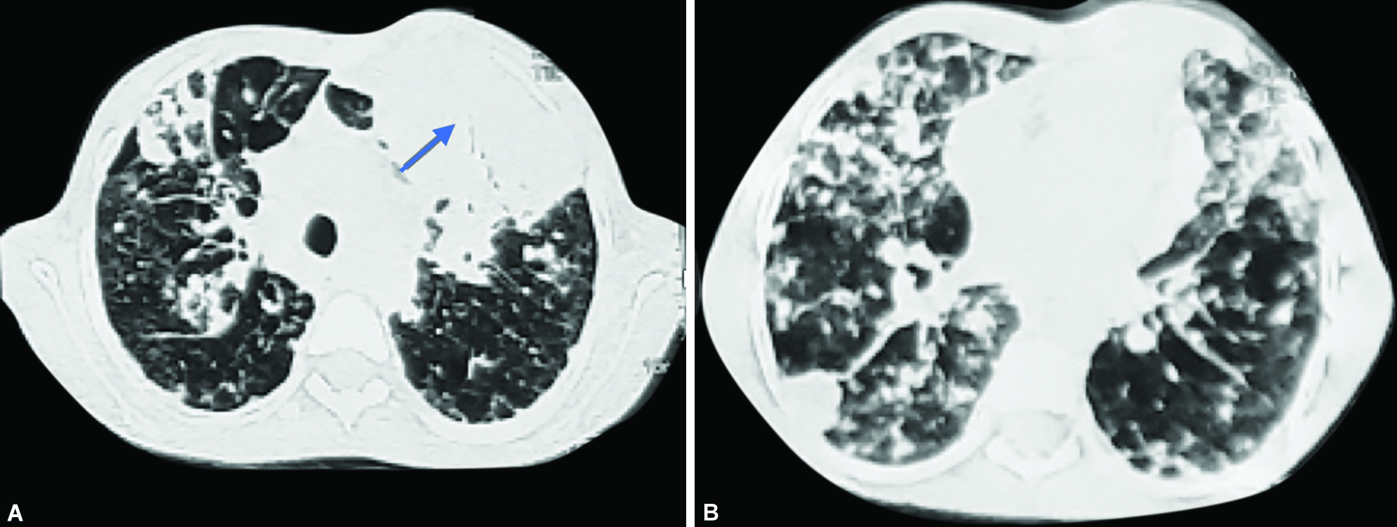 case study of pneumonia in child