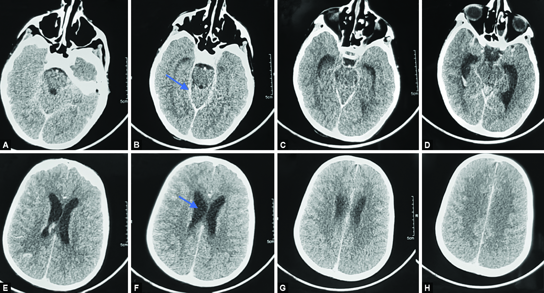 case study of pneumonia in child