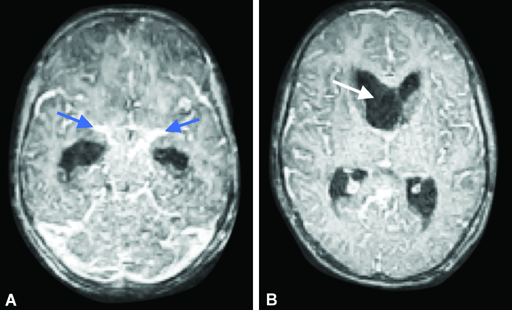 case study of pneumonia in child