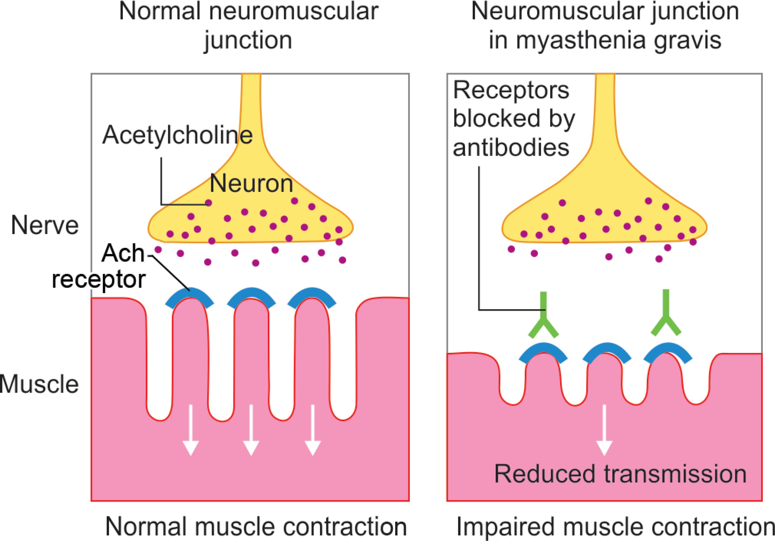 acetylcholine receptor myasthenia gravis