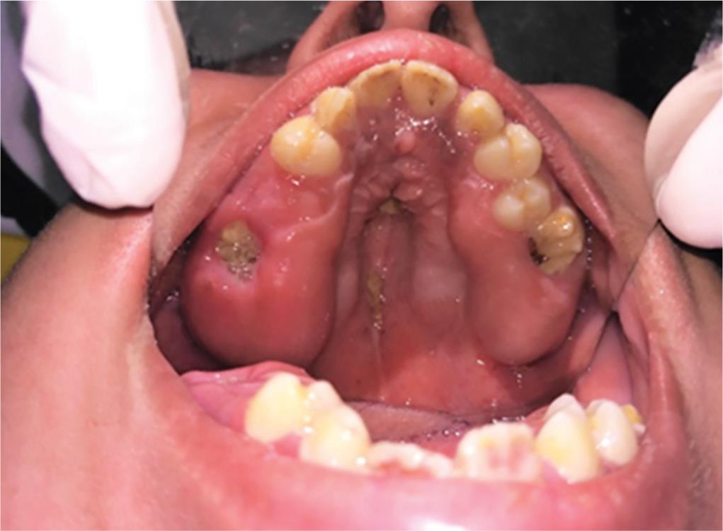 apert syndrome teeth