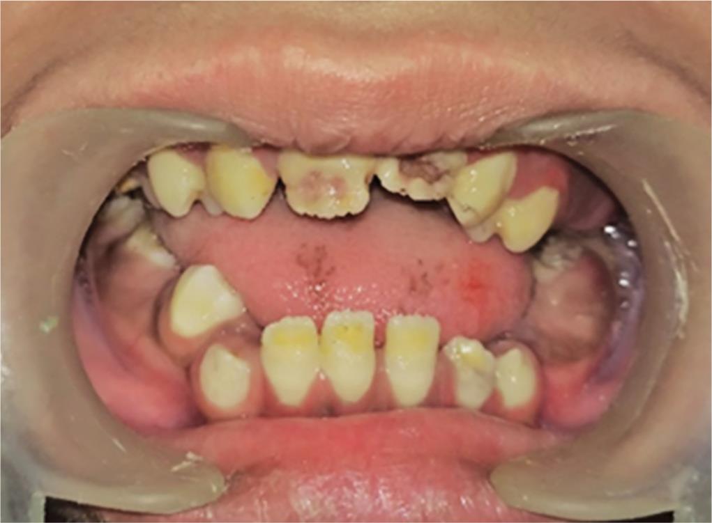 apert syndrome teeth