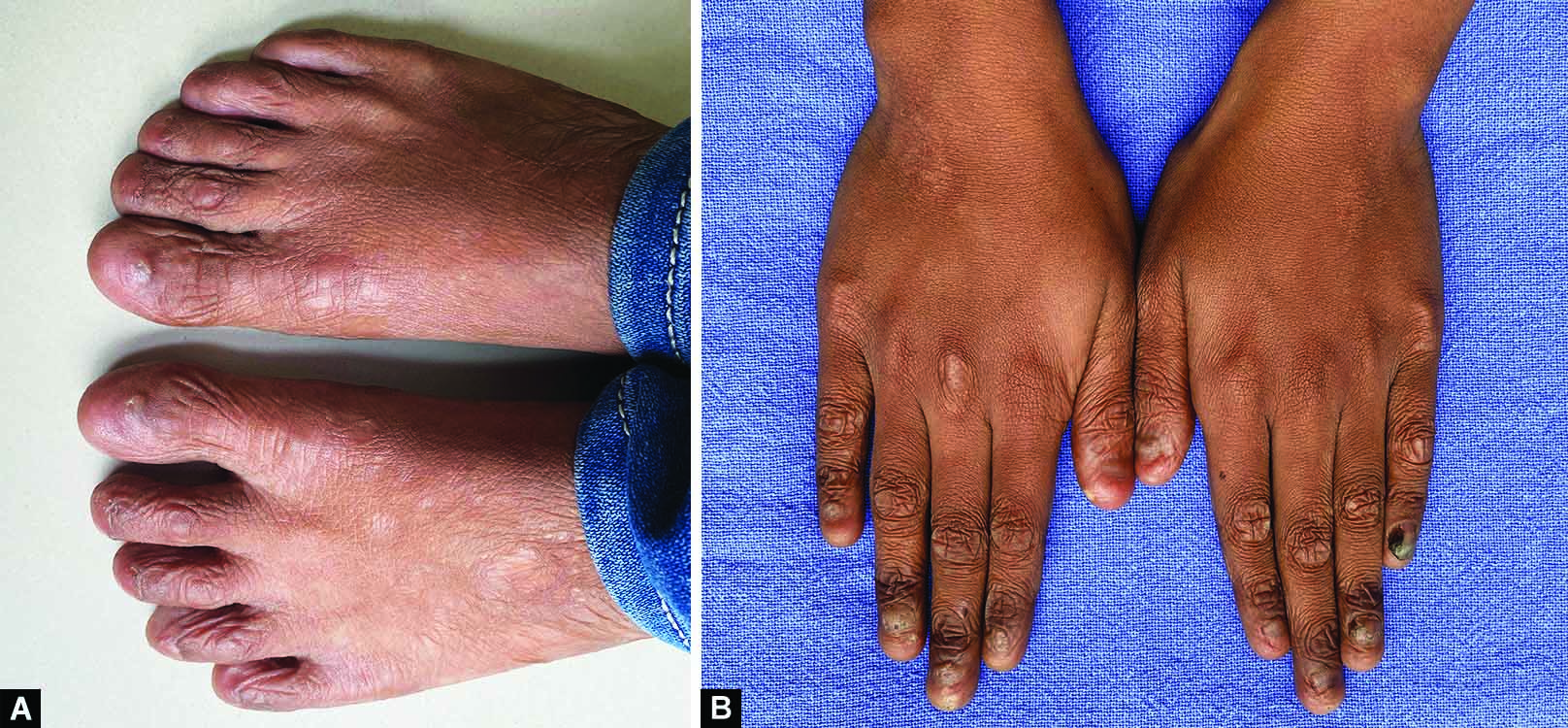 Junctional Epidermolysis Bullosa Genebase