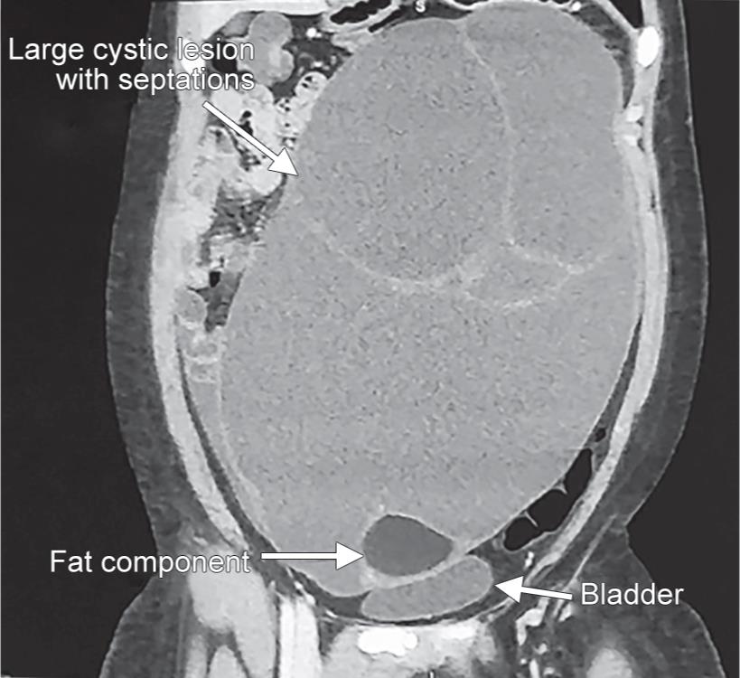 ovarian-collision-tumors