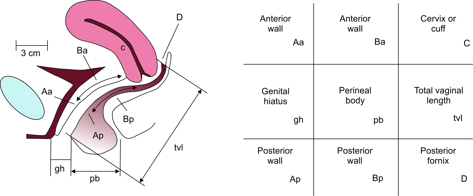 Vaginal Prolapse Grading Vaginal Prolapse Grading