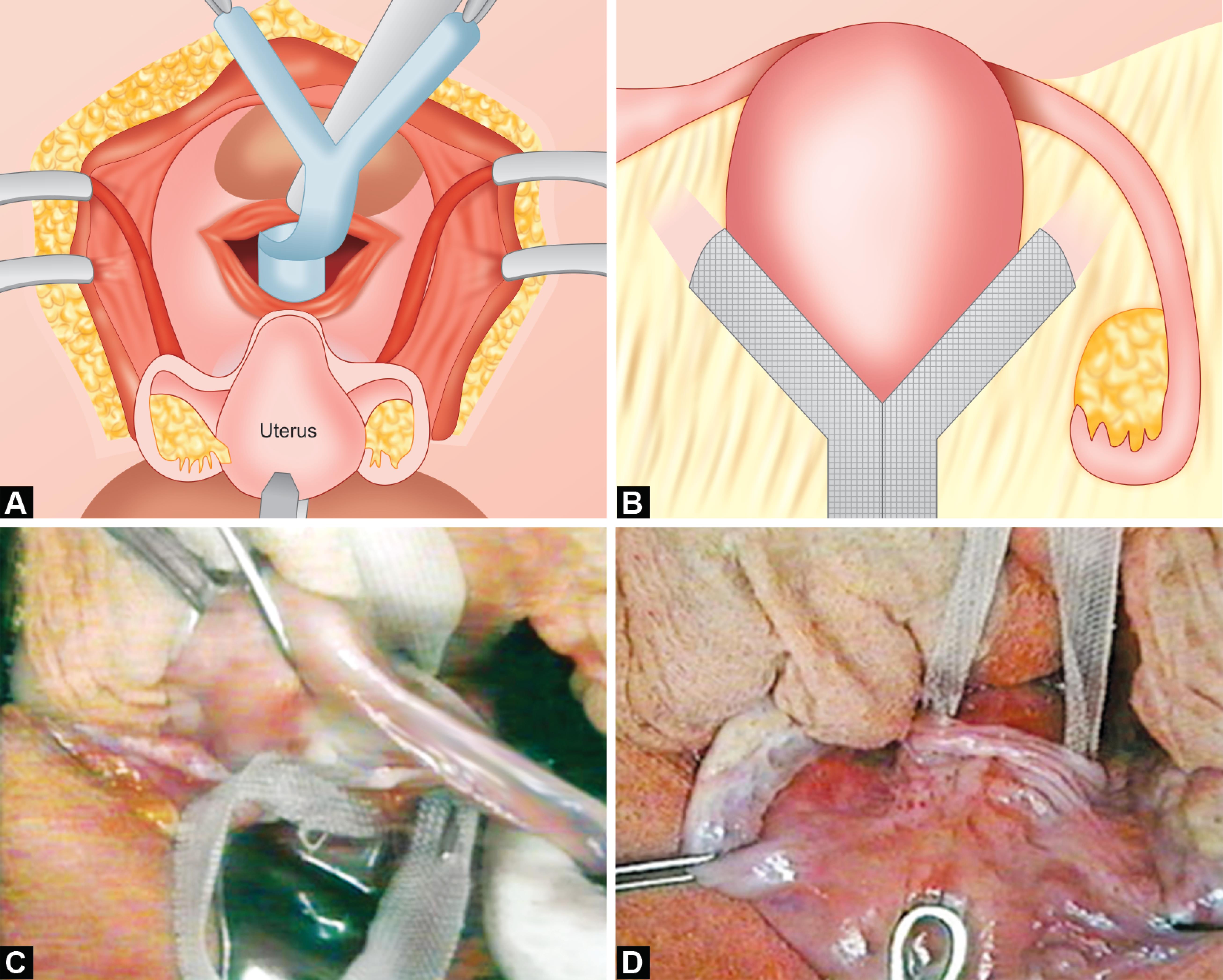 Robotic Assisted Sacrocolpopexy of Uterine and Vaginal Prolapse