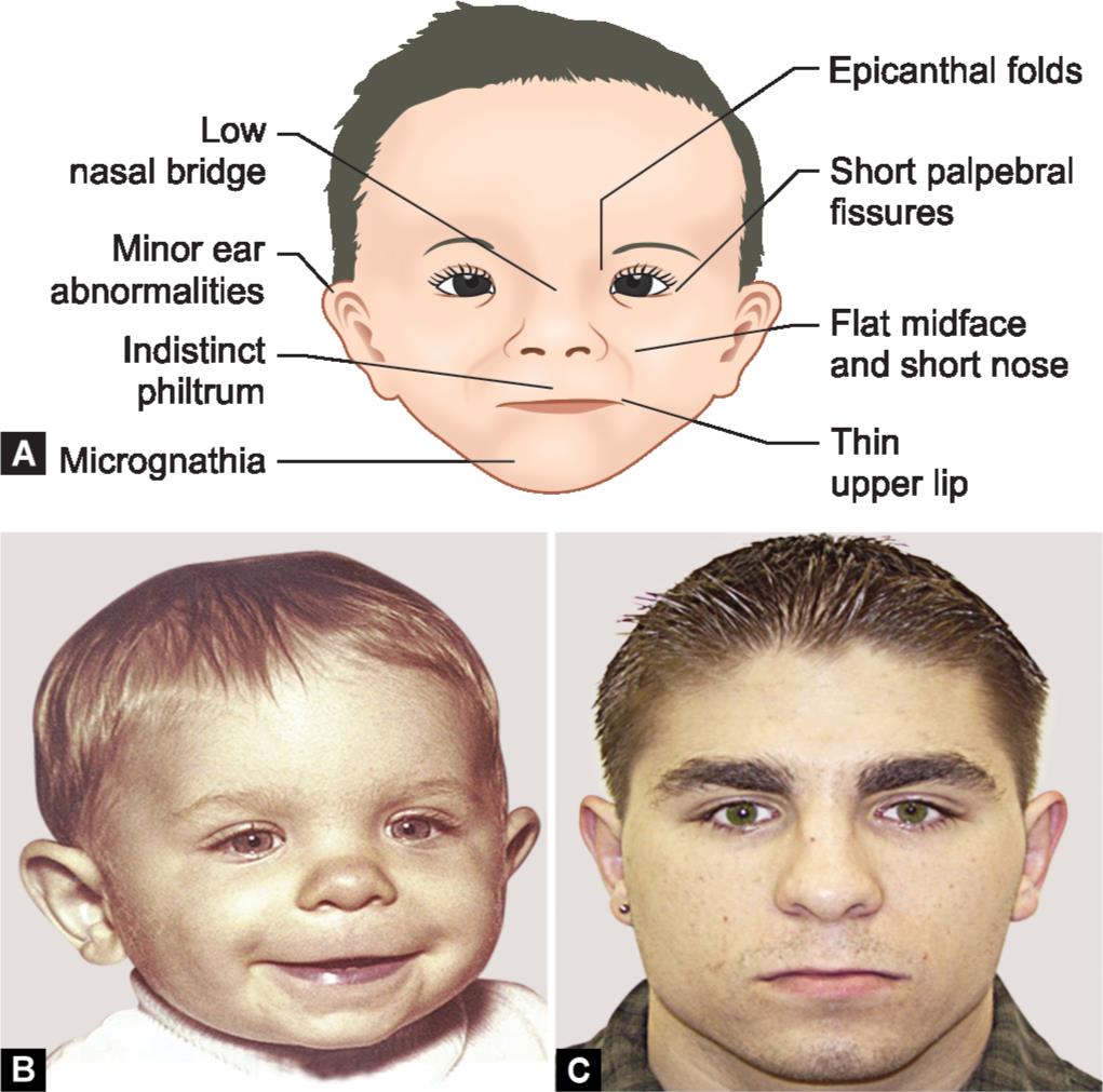 fetal alcohol syndrome children