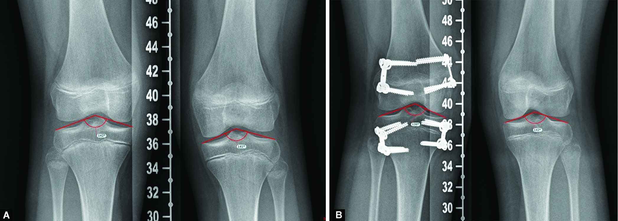 Figure 4 From Recurrent Fracture After Anterior Tensi vrogue.co
