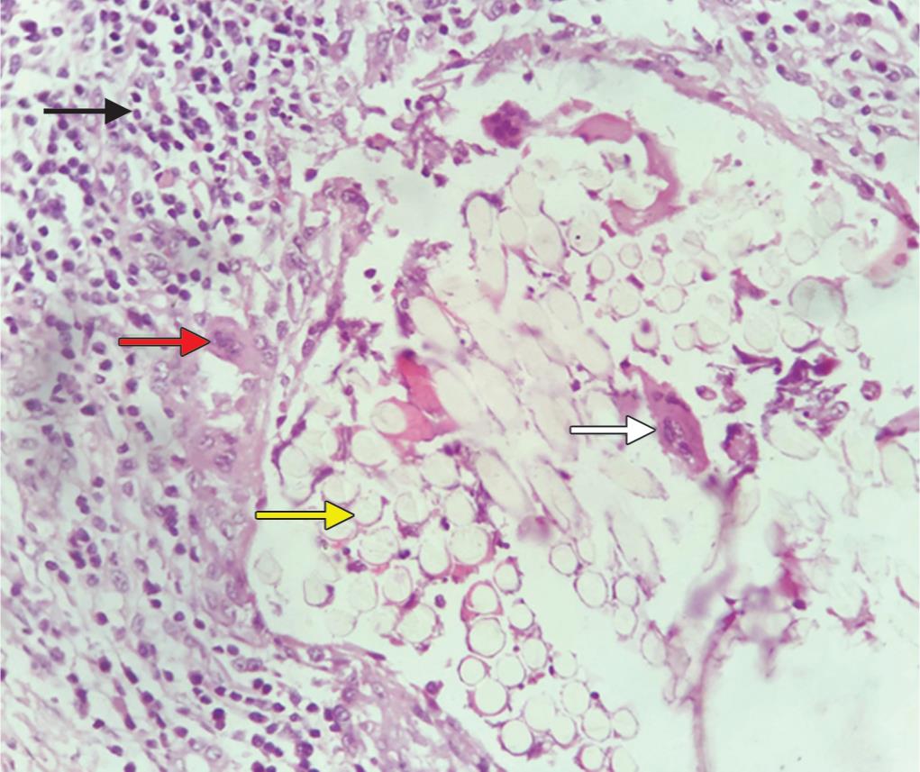 suture-granuloma-in-oral-biopsy-specimen