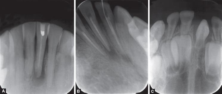 tooth periapical lesion