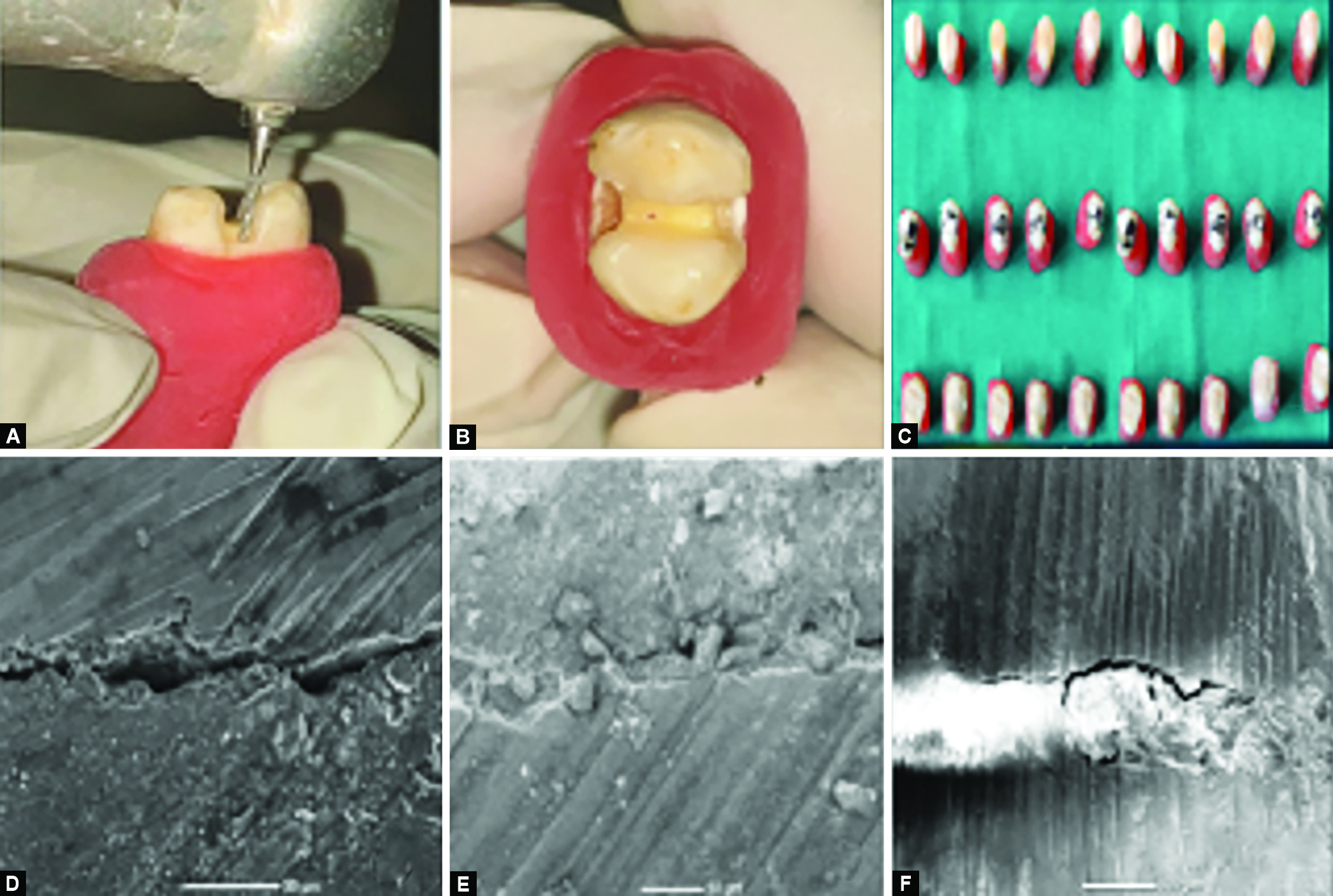 Evaluation of Marginal Adaptation of Three Different Materials Restored ...